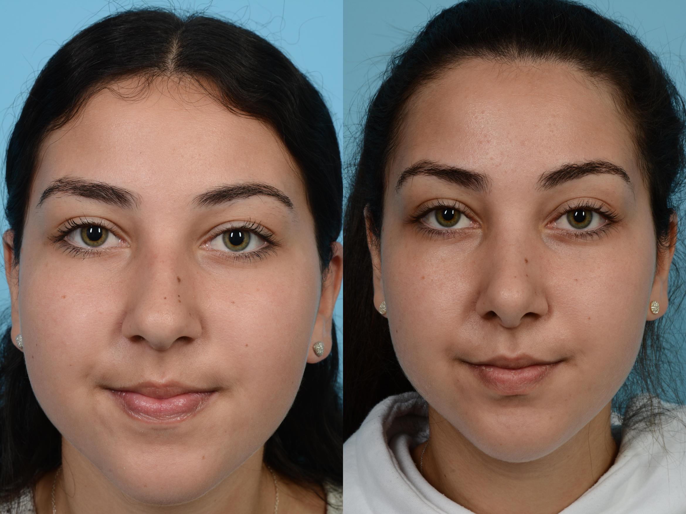 Before & After Rhinoplasty by Dr. Mustoe Case 586 View #1 View in Chicago, IL