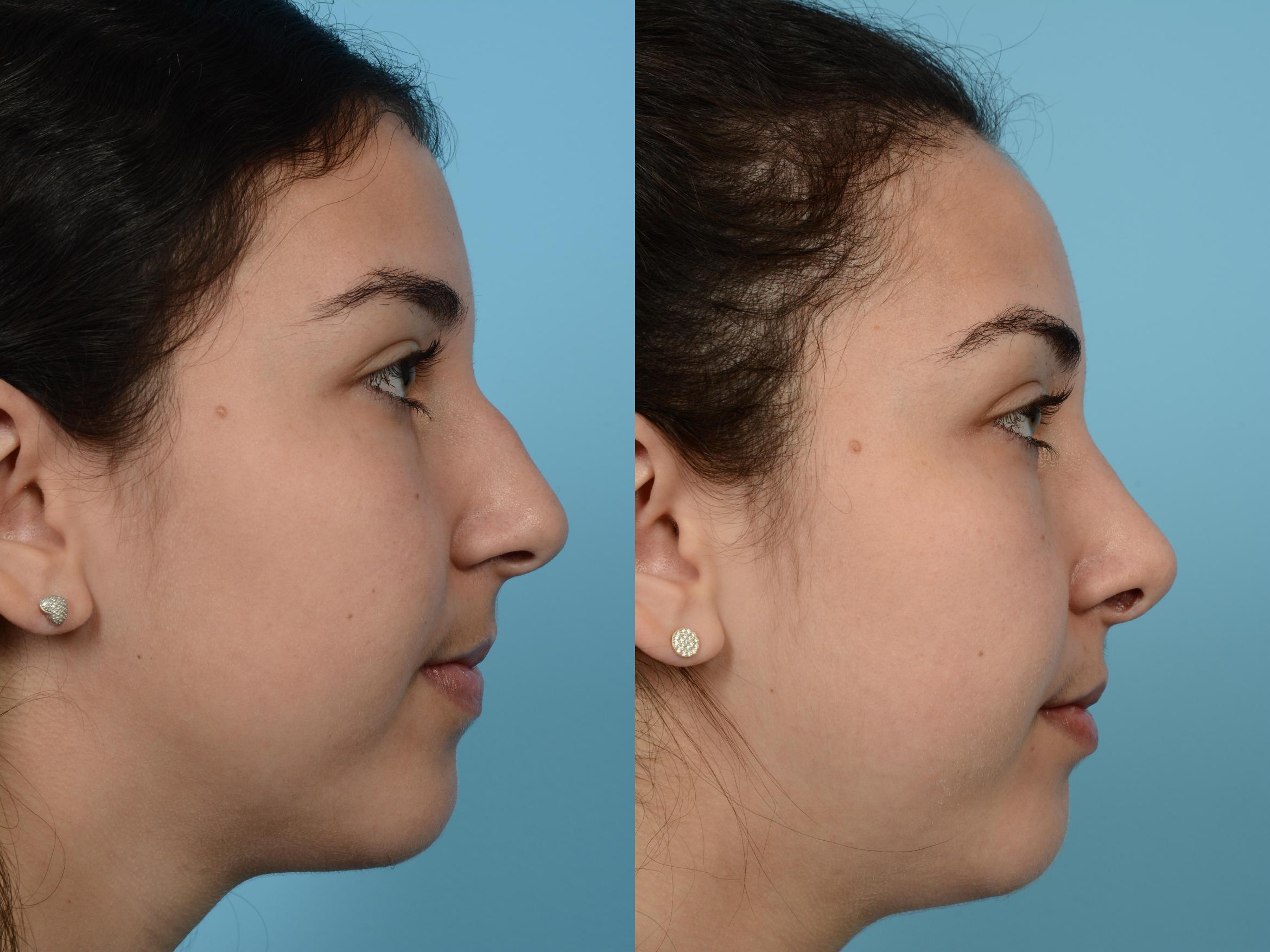 Before & After Rhinoplasty by Dr. Mustoe Case 586 View #3 View in Chicago, IL