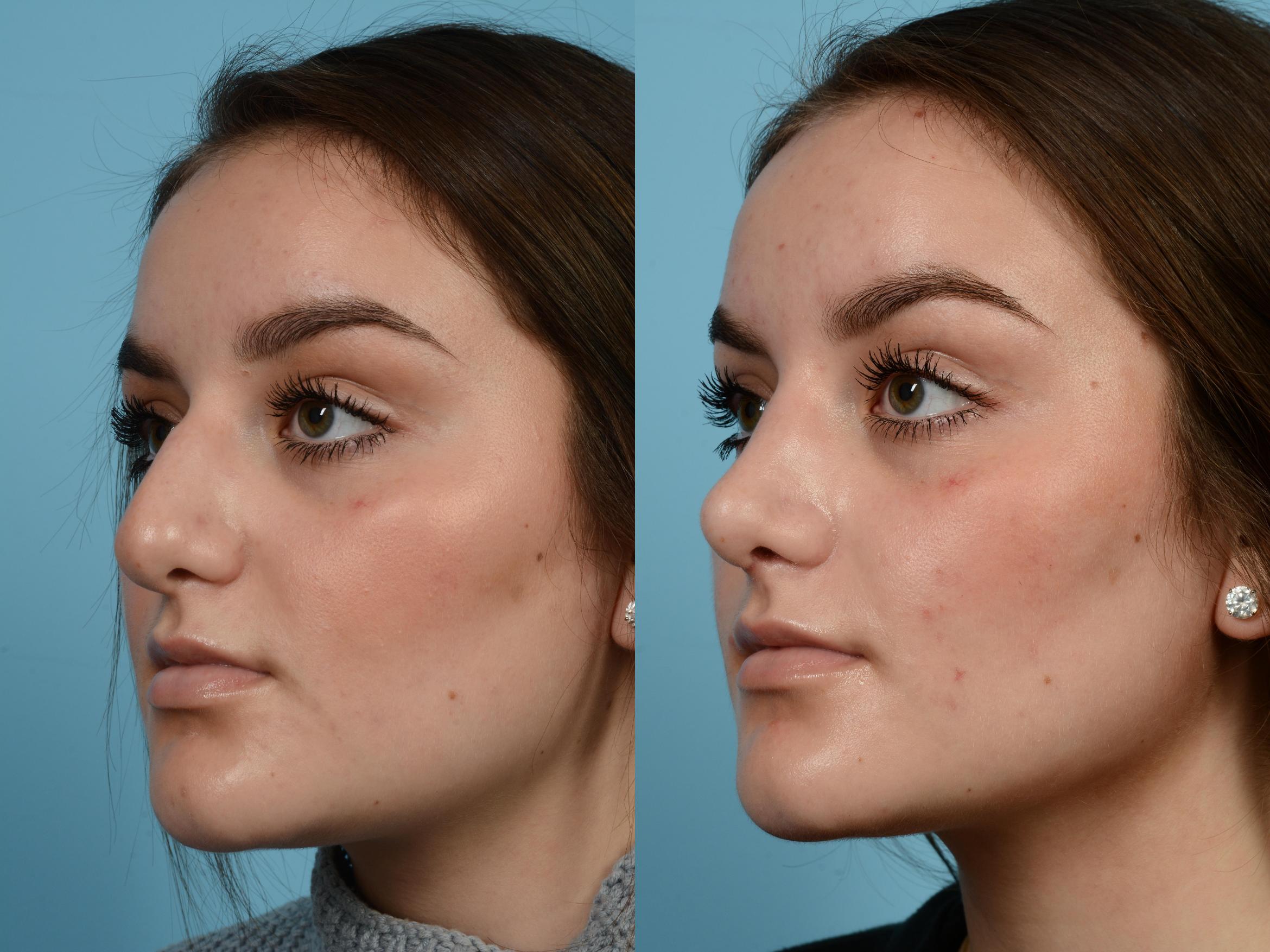 Before & After Rhinoplasty by Dr. Mustoe Case 587 View #1 View in Chicago, IL