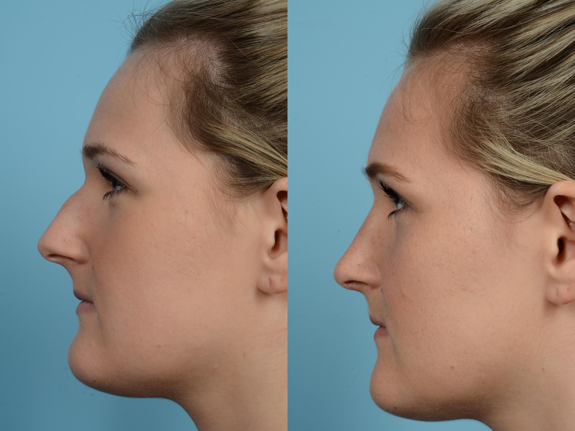 Before & After Rhinoplasty by Dr. Mustoe Case 588 View #1 View in Chicago, IL