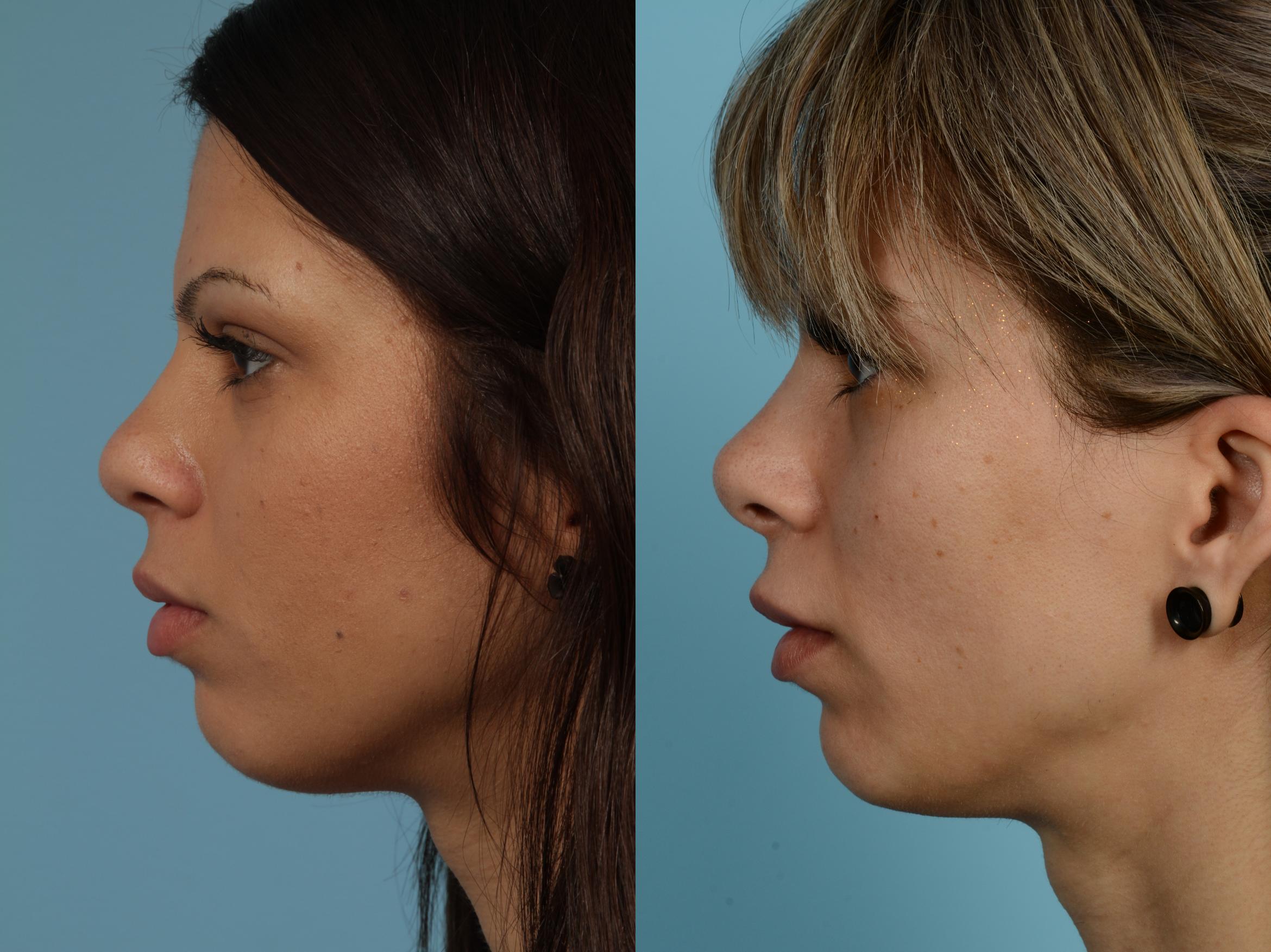 Rhinoplasty Before After Photos Patient 613 Chicago Il Tlkm Plastic Surgery