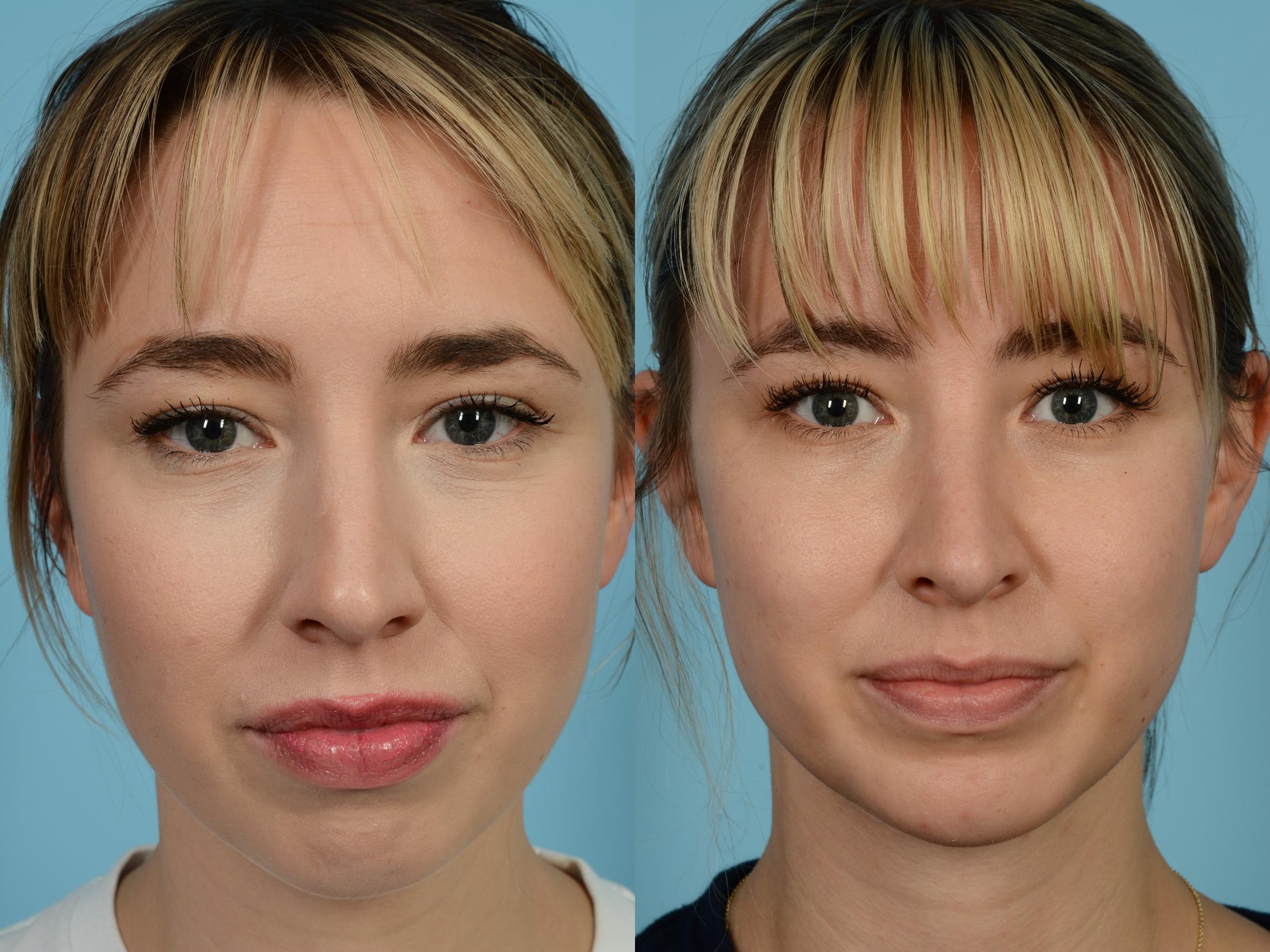 Before & After Rhinoplasty by Dr. Mustoe Case 614 Front View in Chicago, IL