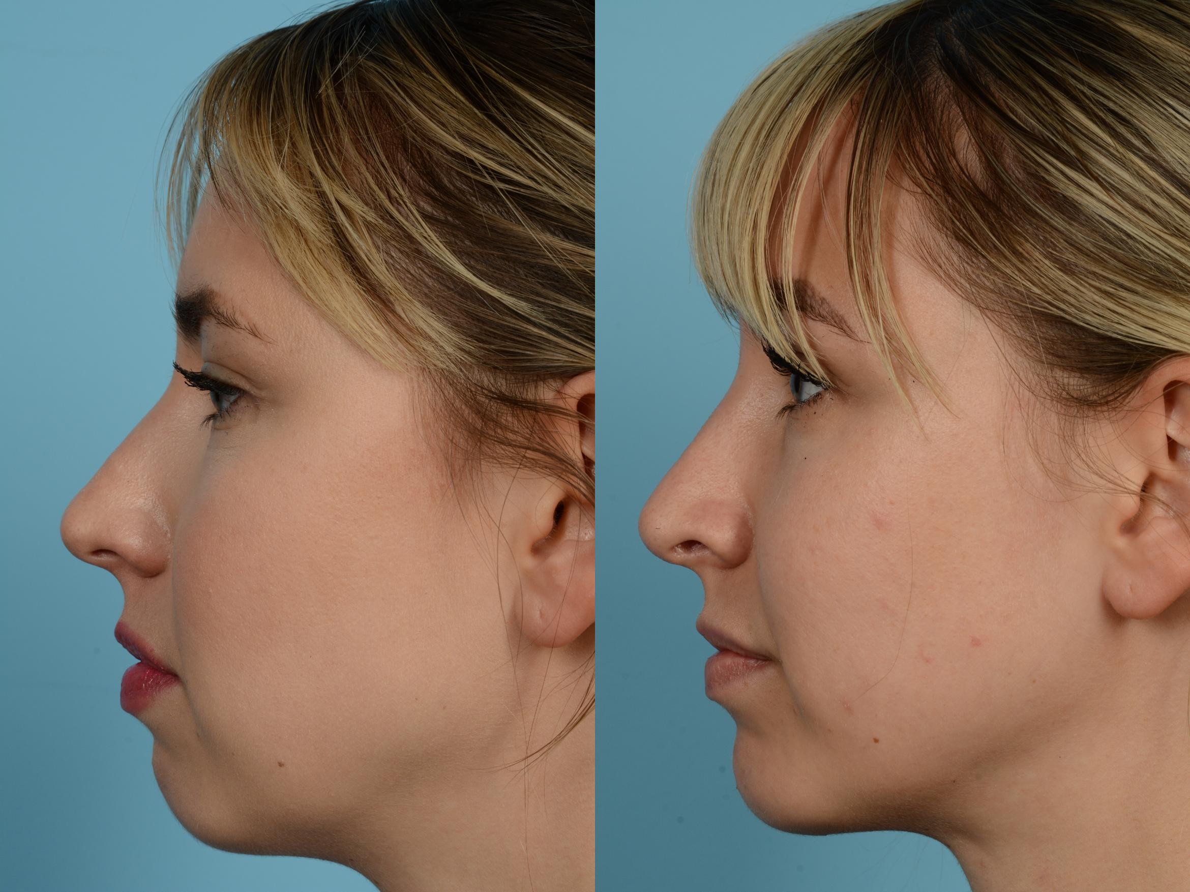 Dr. Mustoe in Chicago performed Rhinoplasty surgery on this female patient 25-30 years old.