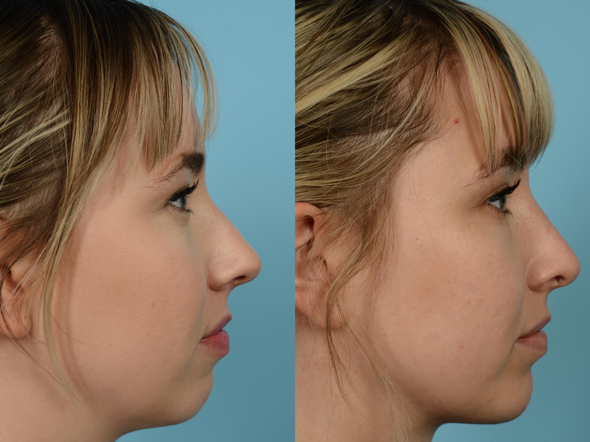 Before & After Rhinoplasty by Dr. Mustoe Case 614 Right Side View in Chicago, IL