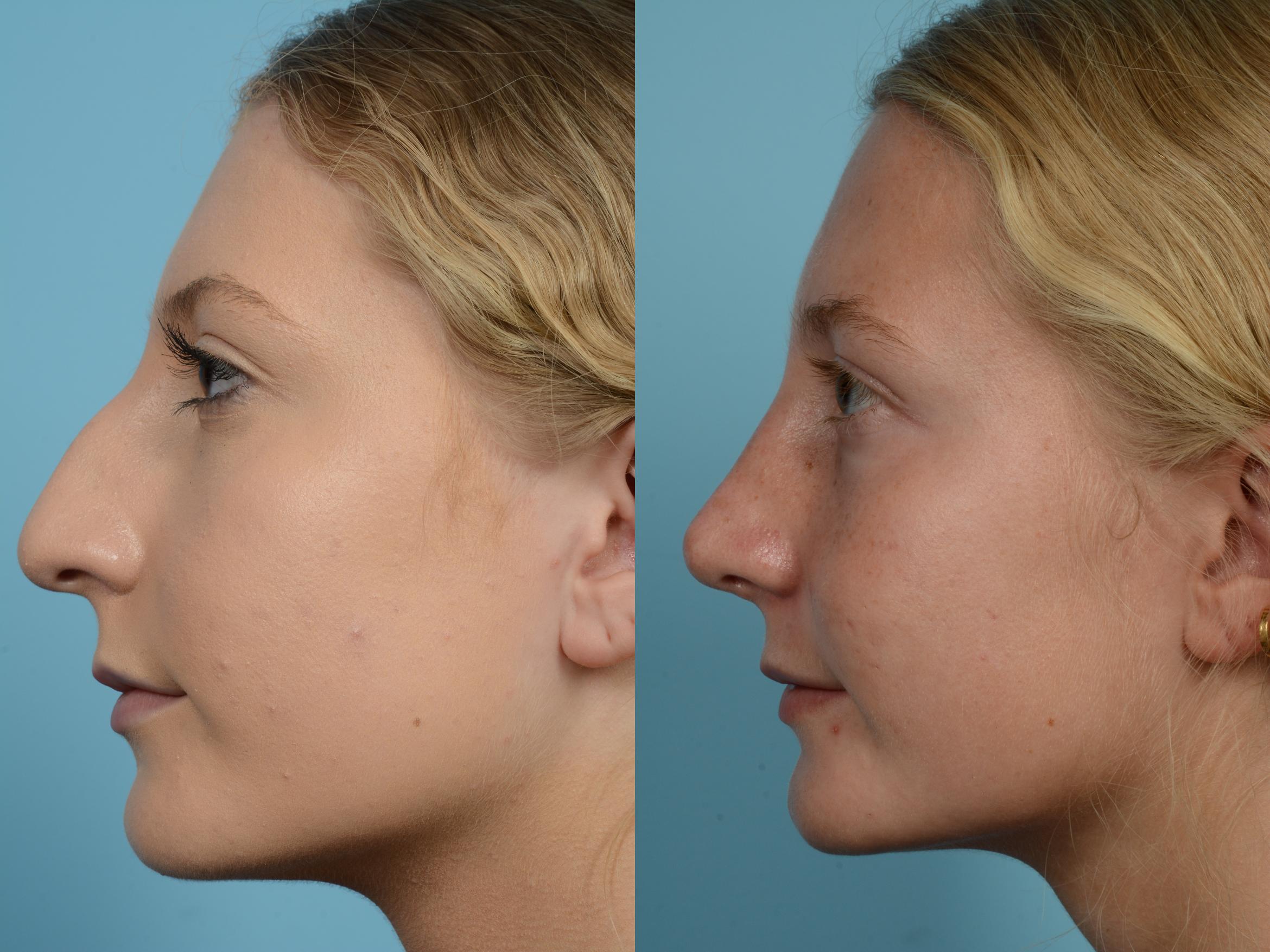 Before & After Rhinoplasty by Dr. Mustoe Case 627 Left Side View in Chicago, IL