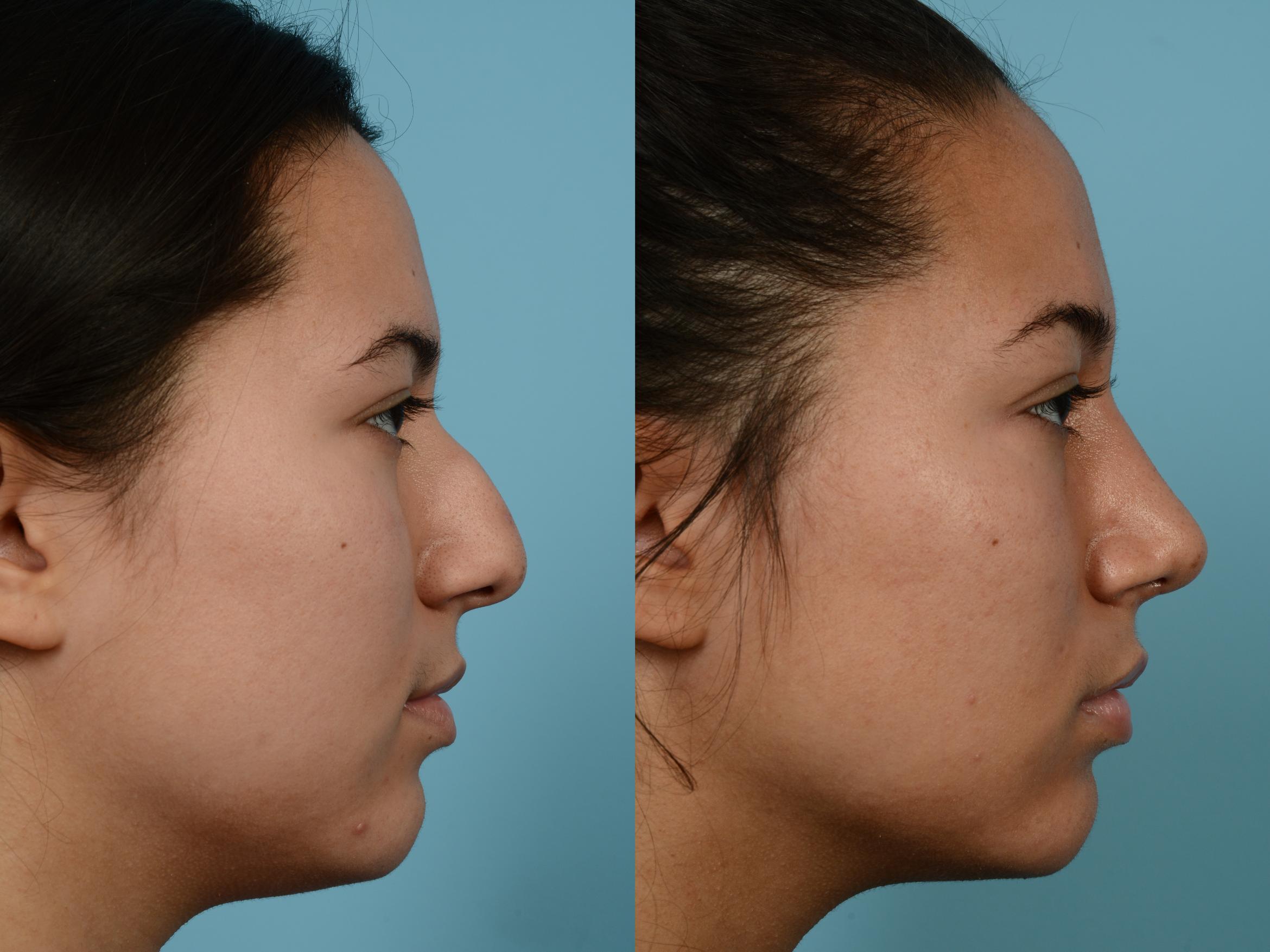 Rhinoplasty by Dr. Mustoe Case 628 Before & After Left Side | Chicago, IL | TLKM Plastic Surgery