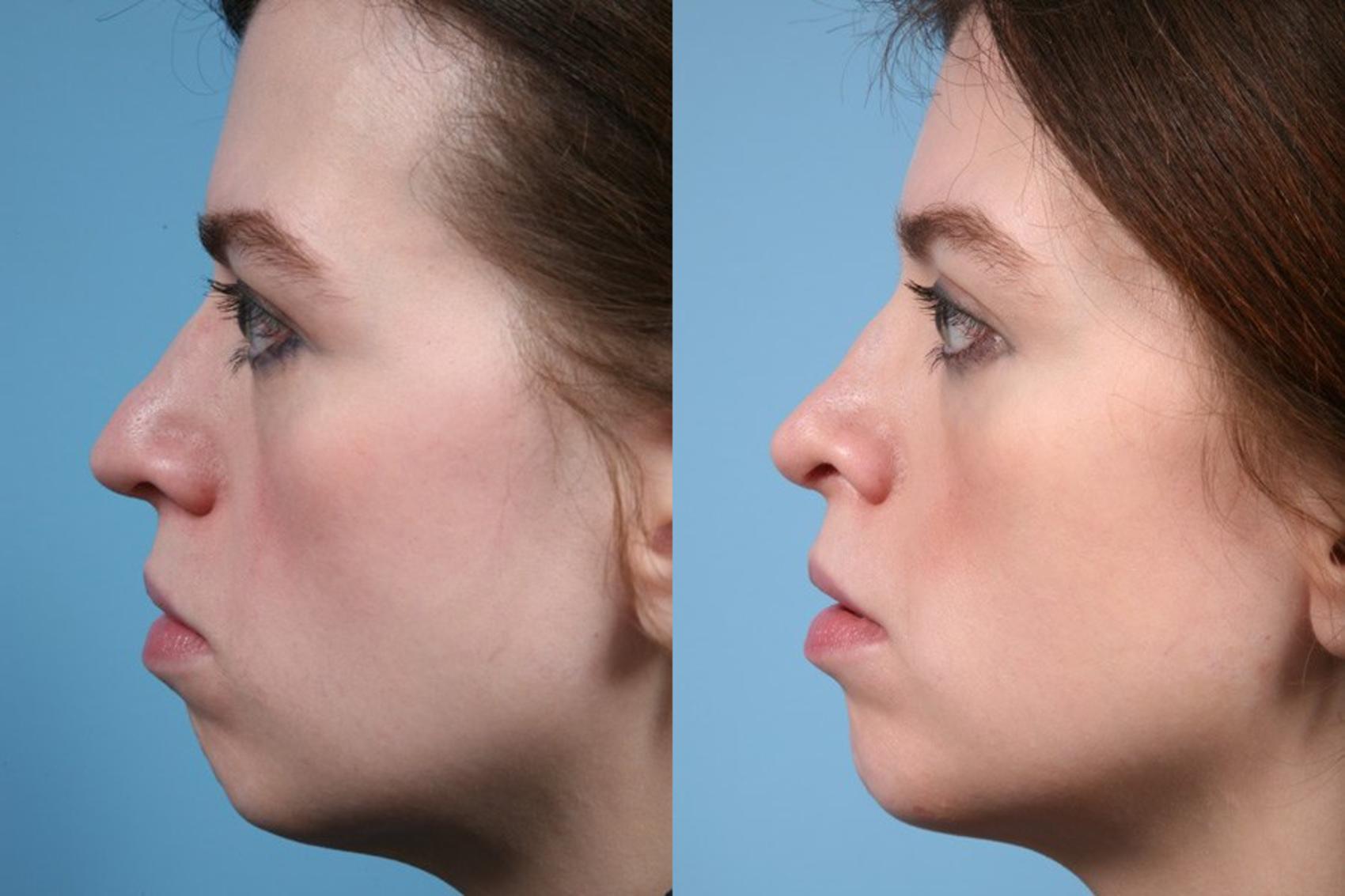 Before & After Rhinoplasty by Dr. Mustoe Case 1 View #1 View in Chicago, IL