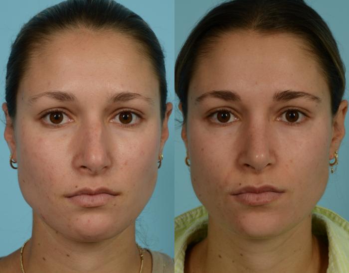 Before & After Rhinoplasty by Dr. Mustoe Case 1001 Front View in Chicago, IL