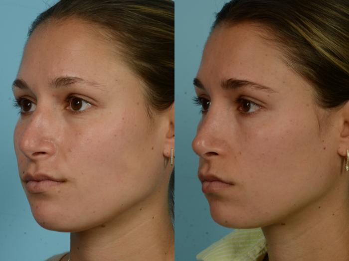 Before & After Rhinoplasty by Dr. Mustoe Case 1001 Left Oblique View in Chicago, IL