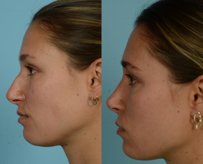 Before & After Rhinoplasty by Dr. Mustoe Case 1001 Left Side View in Chicago, IL