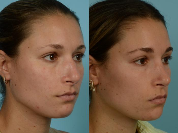 Before & After Rhinoplasty by Dr. Mustoe Case 1001 Right Oblique View in Chicago, IL