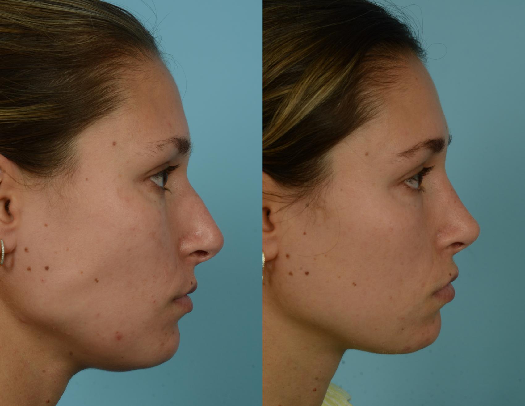 Before & After Rhinoplasty by Dr. Mustoe Case 1001 Right Side View in Chicago, IL