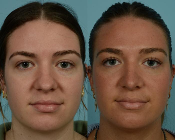 Before & After Rhinoplasty by Dr. Mustoe Case 1009 Front View in Chicago, IL