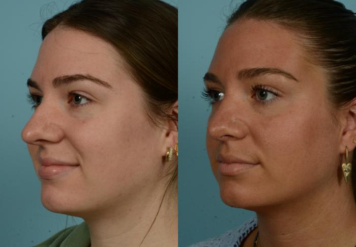 Before & After Rhinoplasty by Dr. Mustoe Case 1009 Left Oblique View in Chicago, IL