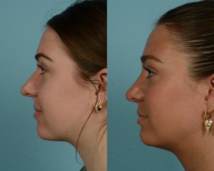 Before & After Rhinoplasty by Dr. Mustoe Case 1009 Left Side View in Chicago, IL