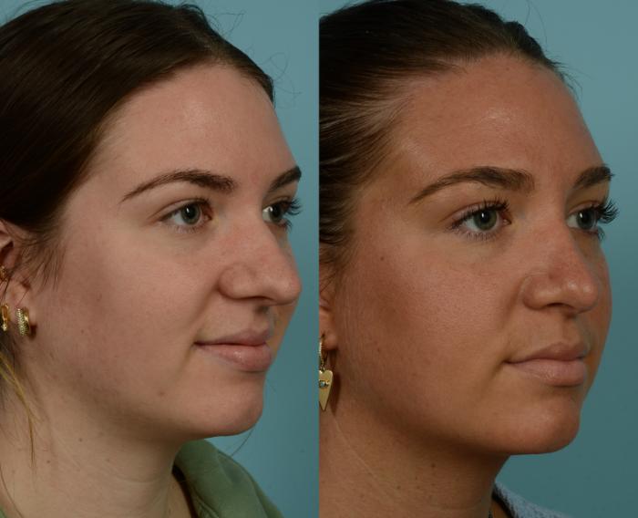 Before & After Rhinoplasty by Dr. Mustoe Case 1009 Right Oblique View in Chicago, IL