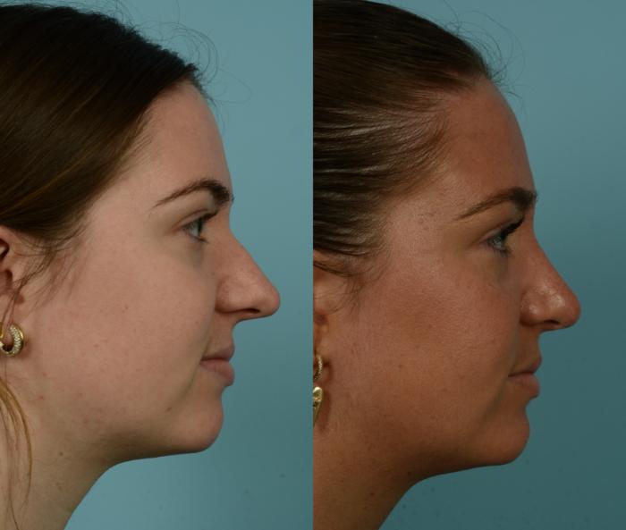 Before & After Rhinoplasty by Dr. Mustoe Case 1009 Right Side View in Chicago, IL