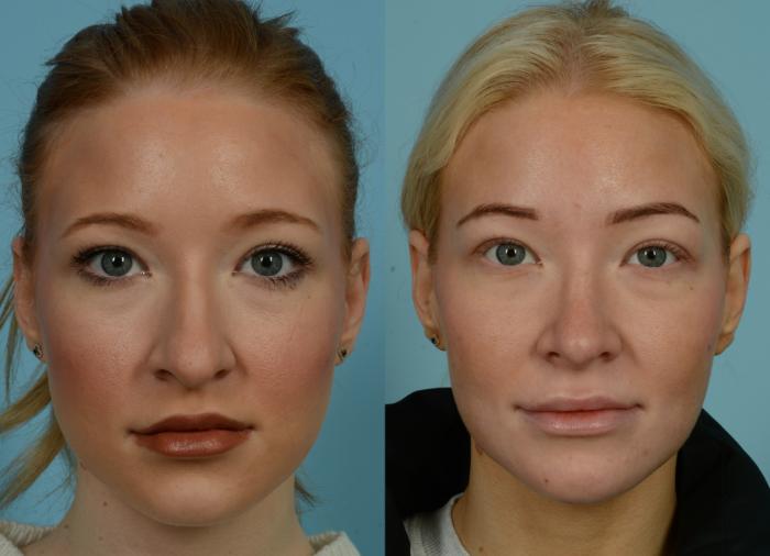 Before & After Rhinoplasty by Dr. Mustoe Case 1018 Front View in Chicago, IL