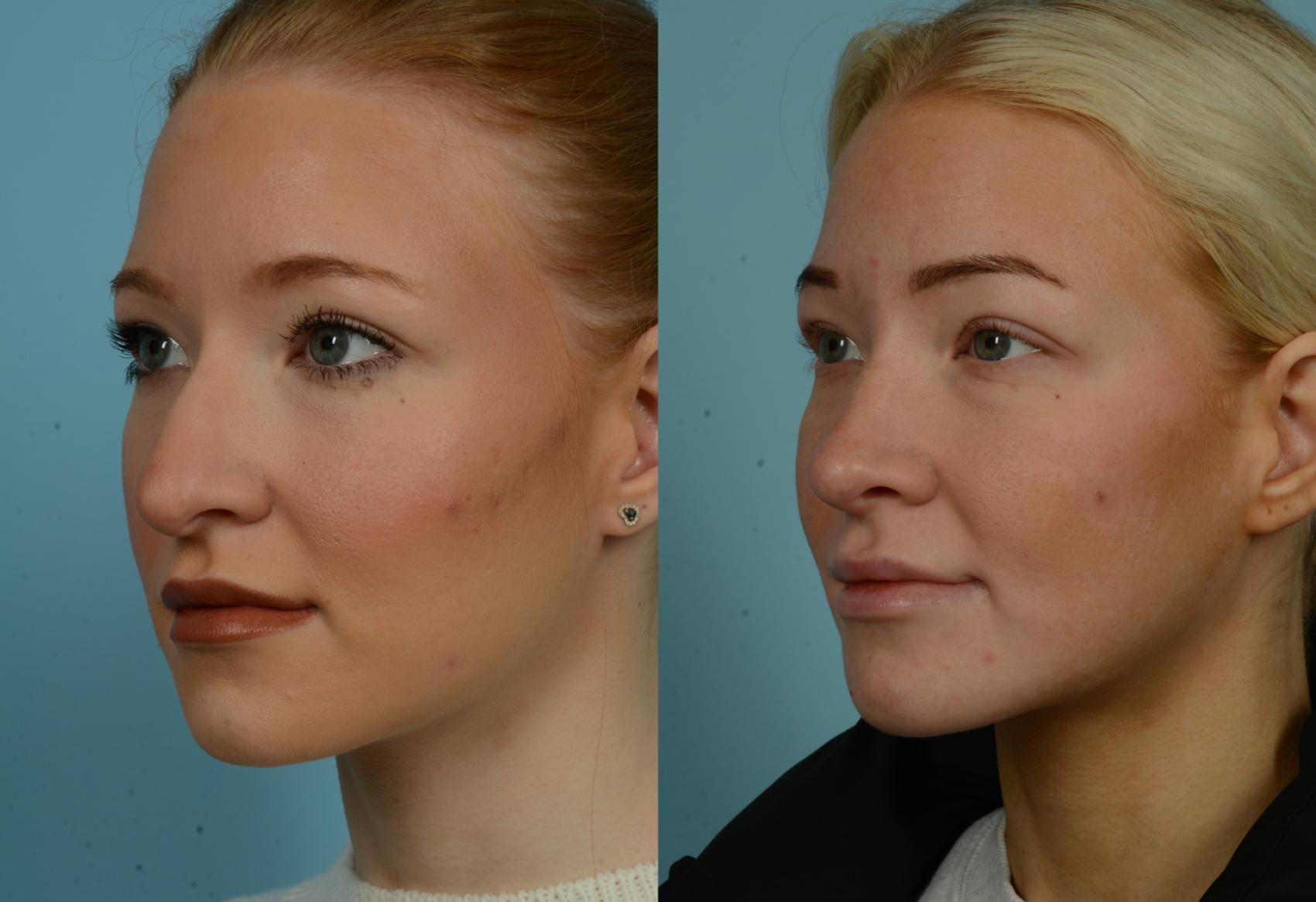 Before & After Rhinoplasty by Dr. Mustoe Case 1018 Left Oblique View in Chicago, IL