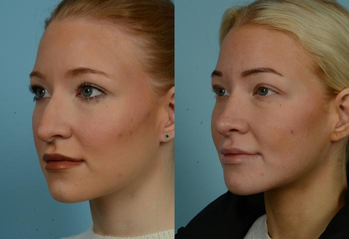 Before & After Rhinoplasty by Dr. Mustoe Case 1018 Left Oblique View in Chicago, IL