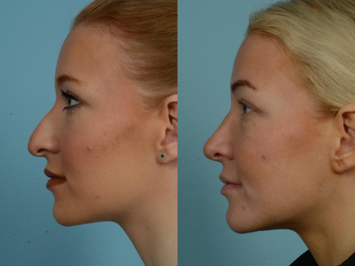 Before & After Rhinoplasty by Dr. Mustoe Case 1018 Left Side View in Chicago, IL