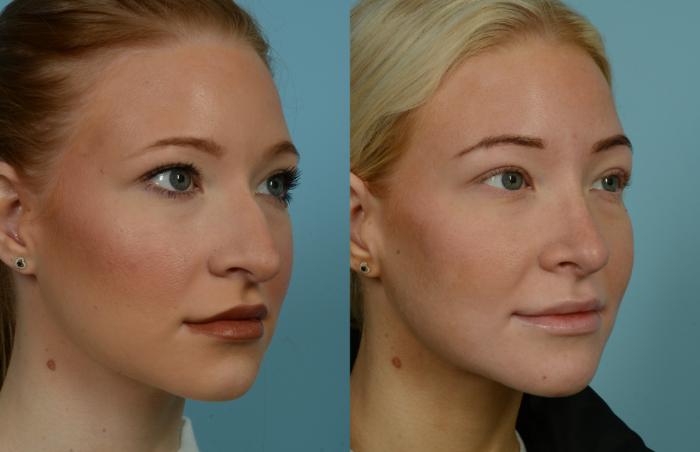 Before & After Rhinoplasty by Dr. Mustoe Case 1018 Right Oblique View in Chicago, IL