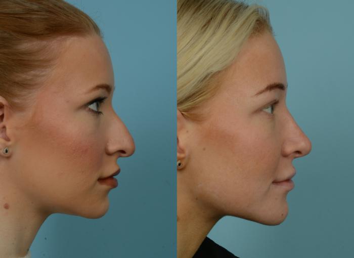 Before & After Rhinoplasty by Dr. Mustoe Case 1018 Right Side View in Chicago, IL