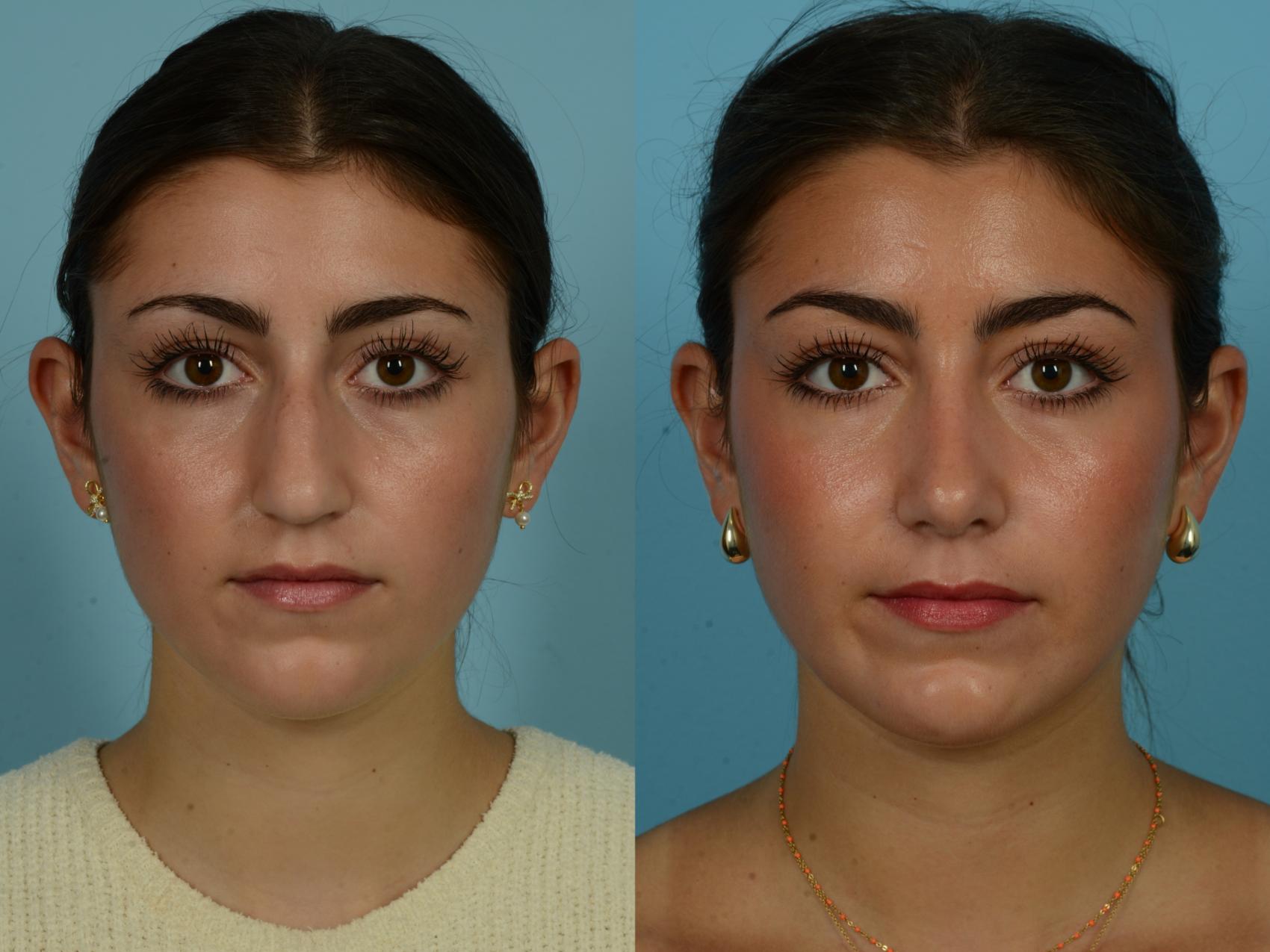 Before & After Rhinoplasty by Dr. Mustoe Case 1034 Front View in Chicago, IL