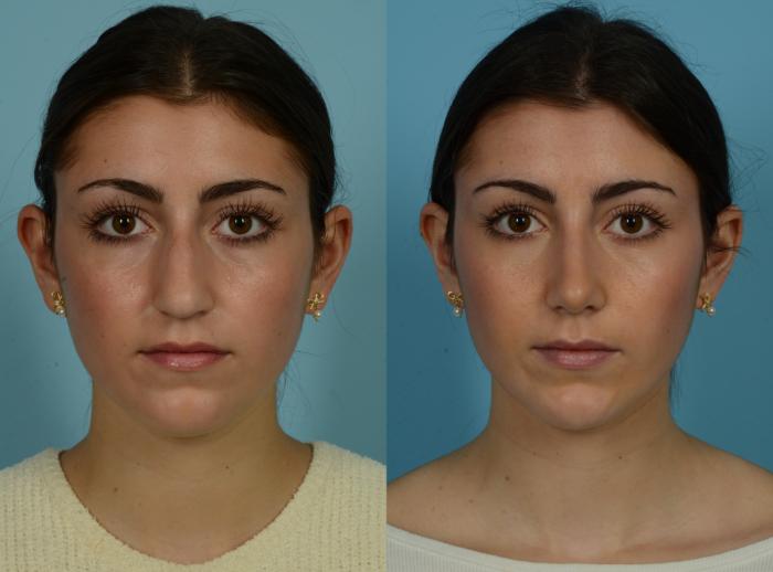 Before & After Rhinoplasty by Dr. Mustoe Case 1034 Front View in Chicago, IL