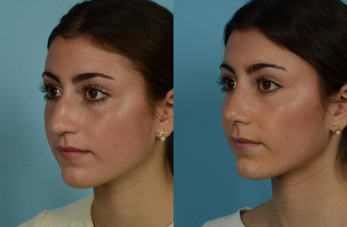 Before & After Rhinoplasty by Dr. Mustoe Case 1034 Left Oblique View in Chicago, IL