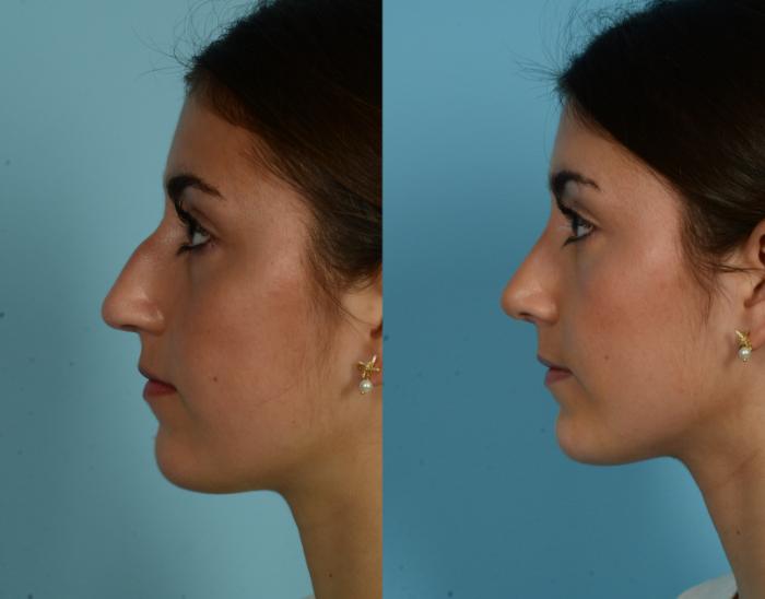 Before & After Rhinoplasty by Dr. Mustoe Case 1034 Left Side View in Chicago, IL