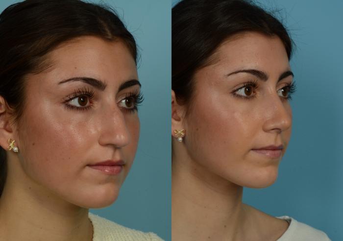 Before & After Rhinoplasty by Dr. Mustoe Case 1034 Right Oblique View in Chicago, IL