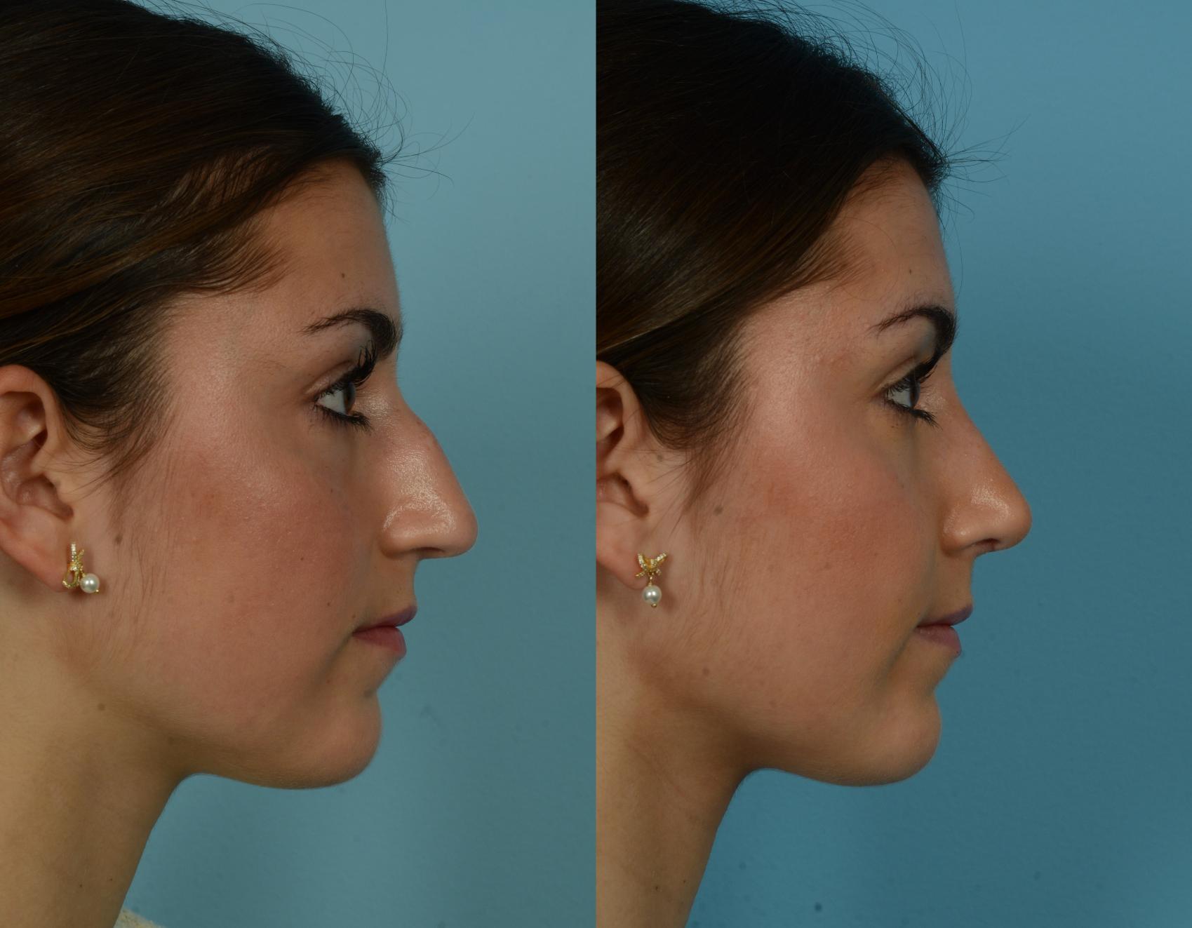 Before & After Rhinoplasty by Dr. Mustoe Case 1034 Right Side View in Chicago, IL