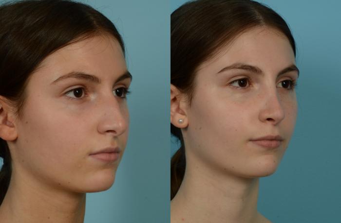 Before & After Rhinoplasty by Dr. Mustoe Case 1050 Right Oblique View in Chicago, IL