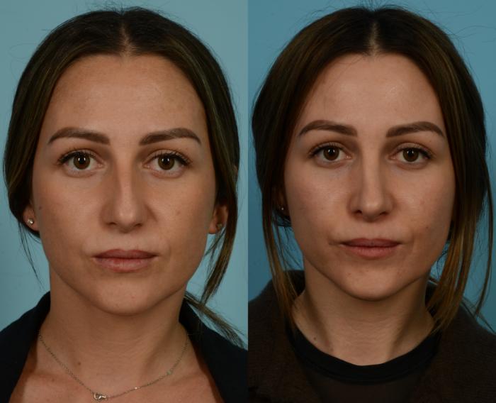 Before & After Rhinoplasty by Dr. Mustoe Case 1055 Front View in Chicago, IL