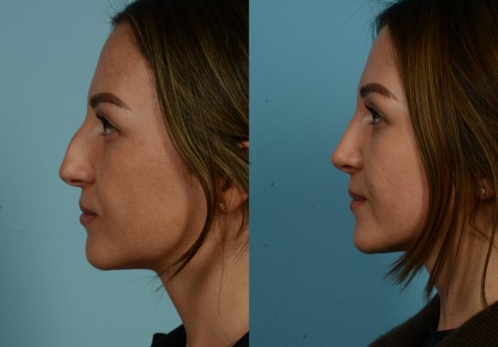 Before & After Rhinoplasty by Dr. Mustoe Case 1055 Left Side View in Chicago, IL