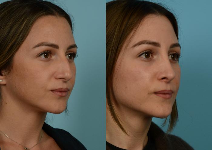 Before & After Rhinoplasty by Dr. Mustoe Case 1055 Right Oblique View in Chicago, IL