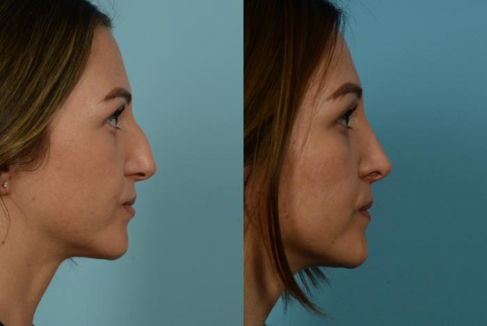 Before & After Rhinoplasty by Dr. Mustoe Case 1055 Right Side View in Chicago, IL