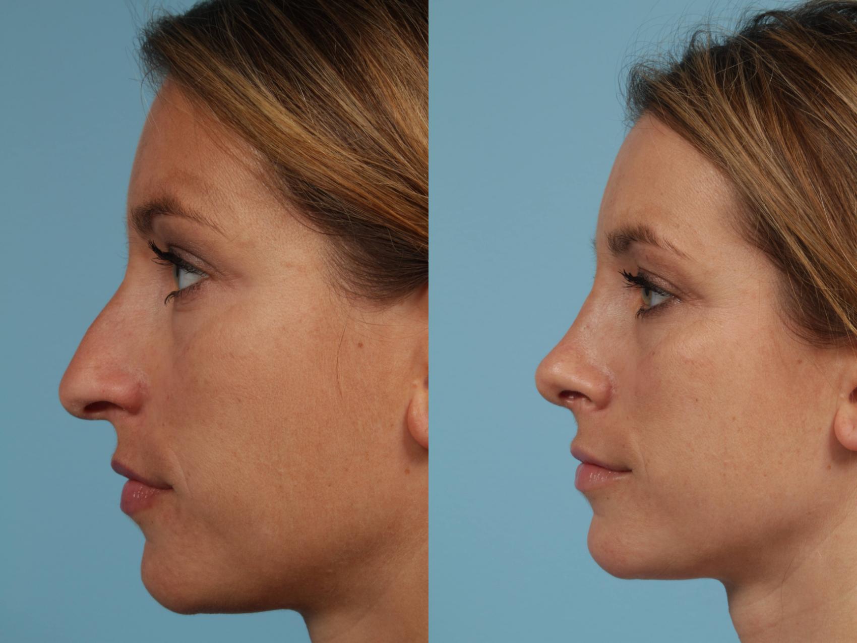 Before & After Rhinoplasty by Dr. Mustoe Case 108 View #1 View in Chicago, IL