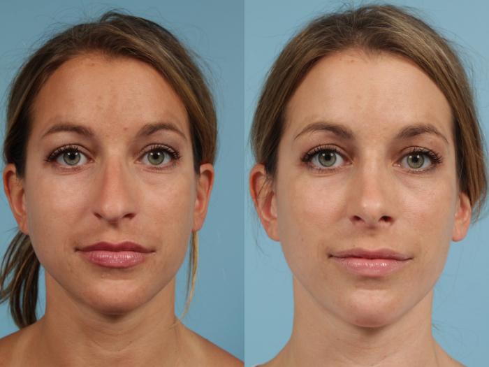 Before & After Rhinoplasty by Dr. Mustoe Case 108 View #2 View in Chicago, IL
