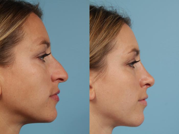 Before & After Rhinoplasty by Dr. Mustoe Case 108 View #3 View in Chicago, IL