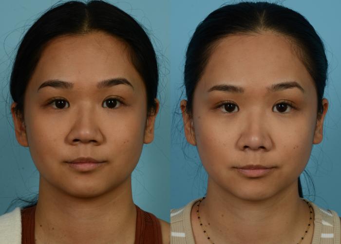 Before & After Rhinoplasty by Dr. Mustoe Case 1087 Front View in Chicago, IL