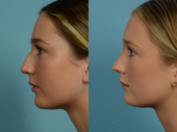 Before & After Rhinoplasty by Dr. Mustoe Case 1089 Left Side View in Chicago, IL