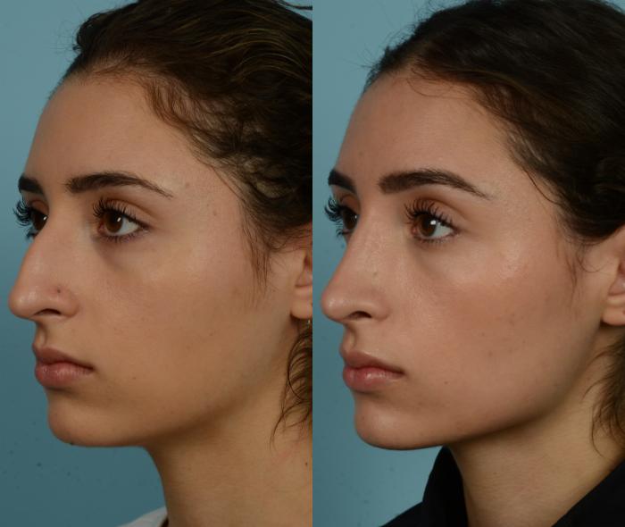 Before & After Rhinoplasty by Dr. Mustoe Case 1092 Left Oblique View in Chicago, IL