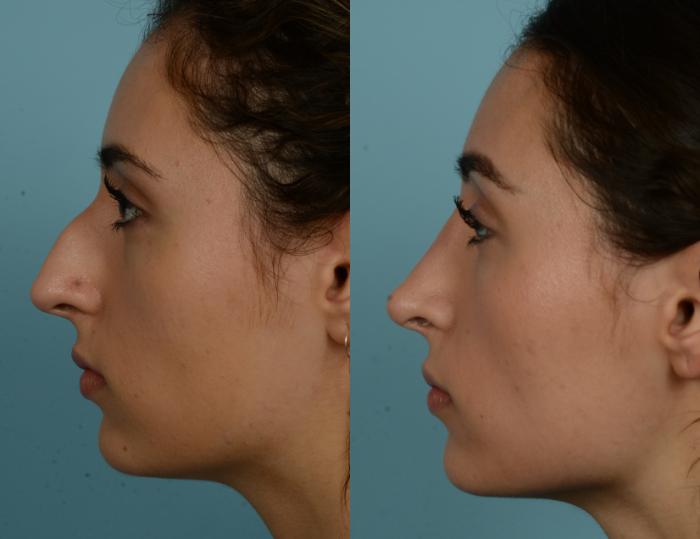 Before & After Rhinoplasty by Dr. Mustoe Case 1092 Left Side View in Chicago, IL