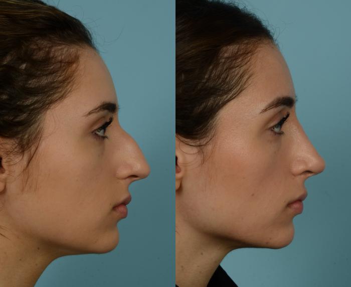 Before & After Rhinoplasty by Dr. Mustoe Case 1092 Right Side View in Chicago, IL