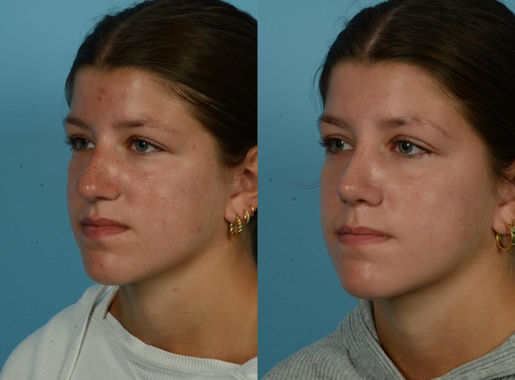 Before & After Rhinoplasty by Dr. Mustoe Case 1093 Left Oblique View in Chicago, IL