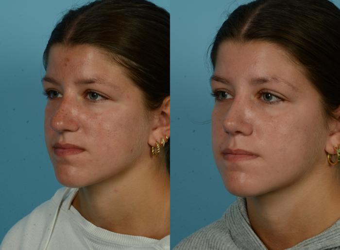 Before & After Rhinoplasty by Dr. Mustoe Case 1093 Left Oblique View in Chicago, IL