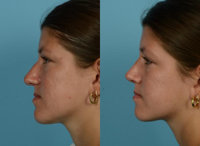 Before & After Rhinoplasty by Dr. Mustoe Case 1093 Left Side View in Chicago, IL