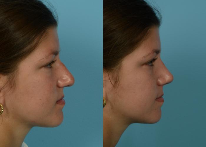 Before & After Rhinoplasty by Dr. Mustoe Case 1093 Right Side View in Chicago, IL